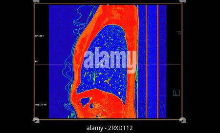 CT-Scan der koronalen Thoraxansicht im Farbmodus für diagnostische Lungenembolie (PE), Lungenkrebs und covid-19. Stockfoto