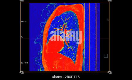 CT-Scan der koronalen Thoraxansicht im Farbmodus für diagnostische Lungenembolie (PE), Lungenkrebs und covid-19. Stockfoto