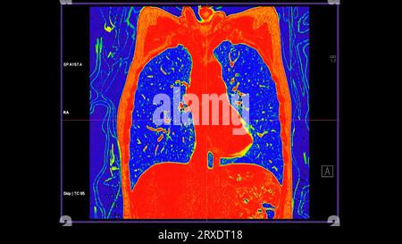 CT-Scan der koronalen Thoraxansicht im Farbmodus für diagnostische Lungenembolie (PE), Lungenkrebs und covid-19. Stockfoto