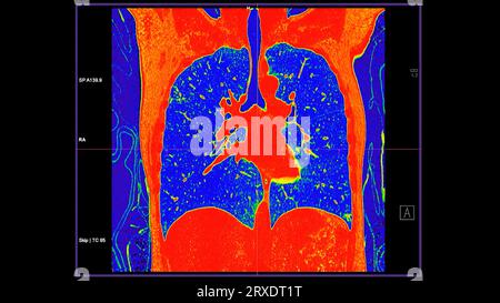 CT-Scan der koronalen Thoraxansicht im Farbmodus für diagnostische Lungenembolie (PE), Lungenkrebs und covid-19. Stockfoto