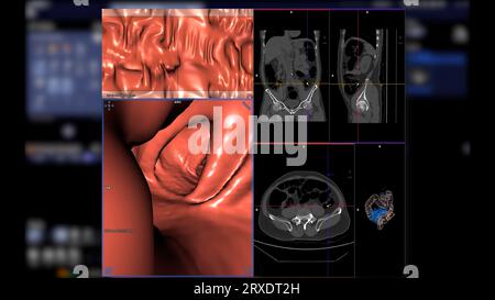 CT-Kolonographie: Vergleich von 2D-axialen, sagittalen, koronalen und 3D-Rendering-Bildern für das Screening von Kolorektalkarzinomen. Für jährliche Gesundheits-Check-ups zum Screening Stockfoto