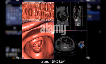 CT-Kolonographie: Vergleich von 2D-axialen, sagittalen, koronalen und 3D-Rendering-Bildern für das Screening von Kolorektalkarzinomen. Für jährliche Gesundheits-Check-ups zum Screening Stockfoto