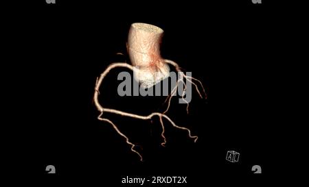 CT Cardiac 3D Rendering oder CTA Coronary Artery zur Prävention von Koronararterienerkrankungen. Stockfoto