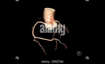 CT Cardiac 3D Rendering oder CTA Coronary Artery zur Prävention von Koronararterienerkrankungen. Stockfoto