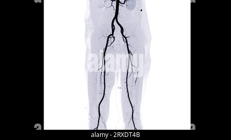 CTA-Ablauf der Femoralarterie zeigt Femoralarterie für die Diagnose akuter oder chronischer peripherer arterieller Verschlusskrankheit. Stockfoto