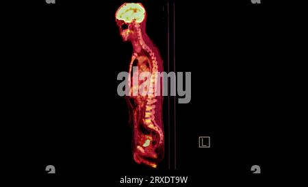 PET-CT-Bild der sagittalen Ganzkörperebene des menschlichen Körpers. Positronen-Emissions-Computertomographie. Stockfoto