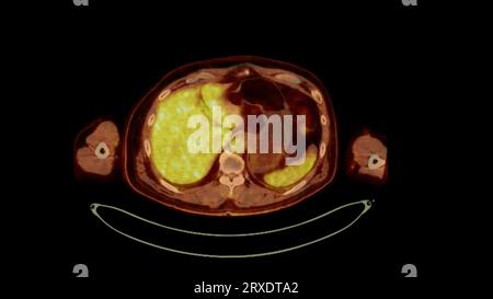 PET-CT-Bild der Ganzkörper-Axialebene des menschlichen Körpers. Positronen-Emissions-Computertomographie. Stockfoto