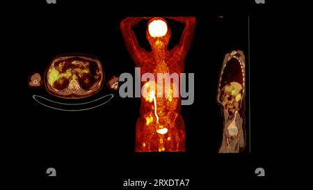 PET-CT-Bild des gesamten menschlichen Körpers axiale, koronale und sagittale Ebene. Positronen-Emissions-Computertomographie. Stockfoto