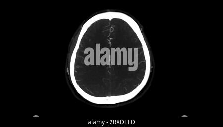 CTA-HIRN- oder CT-Angiographie der axialen mip-Ansicht des Gehirns mit Darstellung der A. cerebri. Stockfoto