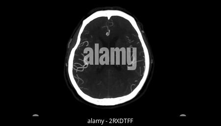 CTA-HIRN- oder CT-Angiographie der axialen mip-Ansicht des Gehirns mit Darstellung der A. cerebri. Stockfoto