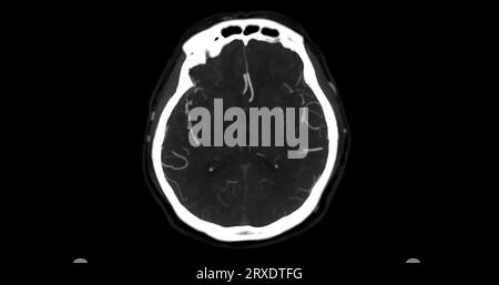 CTA-HIRN- oder CT-Angiographie der axialen mip-Ansicht des Gehirns mit Darstellung der A. cerebri. Stockfoto