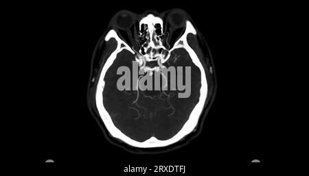 CTA-HIRN- oder CT-Angiographie der axialen mip-Ansicht des Gehirns mit Darstellung der A. cerebri. Stockfoto