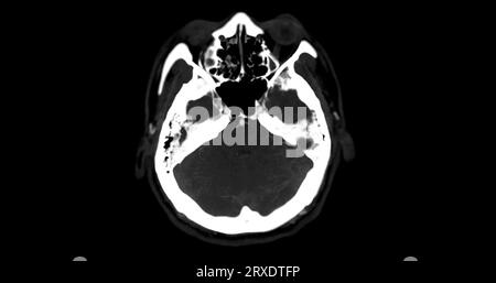 CTA-HIRN- oder CT-Angiographie der axialen mip-Ansicht des Gehirns mit Darstellung der A. cerebri. Stockfoto