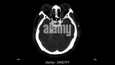 CTA-HIRN- oder CT-Angiographie der axialen mip-Ansicht des Gehirns mit Darstellung der A. cerebri. Stockfoto