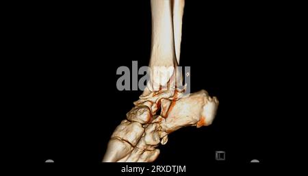 CT-Sprunggelenk-Scan oder Computertomographie des 3D-Rendering-Bildes des Sprunggelenks. Stockfoto