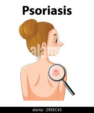 Eine Vektor-Karikaturillustration, die eine Person mit Psoriasis, einer Hautkrankheit, darstellt Stock Vektor