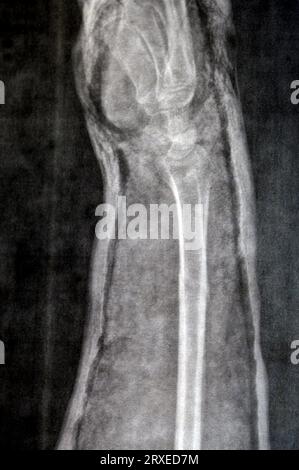 Ein Röntgenbild des rechten Unterarms (irrtümlich links auf dem Film geschrieben) zeigt eine Fraktur des unteren Teils der Ulna in der Besetzung für 4 Wochen und beginnt zu heilen Stockfoto