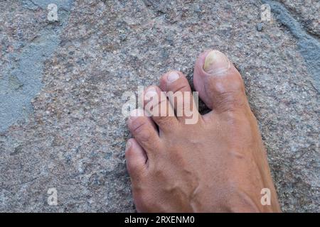 Zehennägel mit Pilzproblemen,Onychomykose, auch bekannt als Tinea unguium, ist eine Pilzinfektion des Nagels, Steinhintergrund. Stockfoto