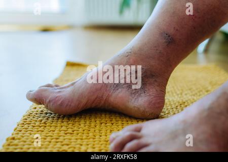 Eine Nahaufnahme von Männerfüßen mit diabetischen Fusskomplikationen. Stockfoto