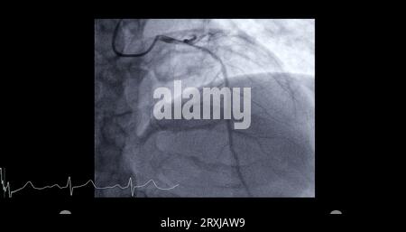 Herzkatheterisierung an der linken anterioren absteigenden Arterie (LAD) kann dem Arzt bei der Diagnose und Behandlung von Problemen in Ihrem Herz und Blutgefäßen wie helfen Stockfoto