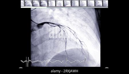 Herzkatheterisierung an der linken anterioren absteigenden Arterie (LAD) kann dem Arzt bei der Diagnose und Behandlung von Problemen in Ihrem Herz und Blutgefäßen wie helfen Stockfoto