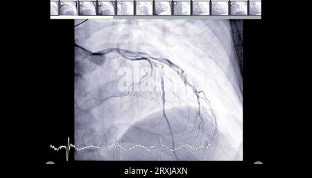 Herzkatheterisierung an der linken anterioren absteigenden Arterie (LAD) kann dem Arzt bei der Diagnose und Behandlung von Problemen in Ihrem Herz und Blutgefäßen wie helfen Stockfoto