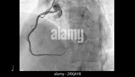 Herzkatheterisierung an der rechten Koronararterie (RCA) kann dem Arzt helfen, Probleme in Ihrem Herz und Ihren Blutgefäßen, wie z. B. ein Herz bei, zu diagnostizieren und zu behandeln Stockfoto