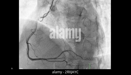 Herzkatheterisierung an der rechten Koronararterie (RCA) kann dem Arzt helfen, Probleme in Ihrem Herz und Ihren Blutgefäßen, wie z. B. ein Herz bei, zu diagnostizieren und zu behandeln Stockfoto