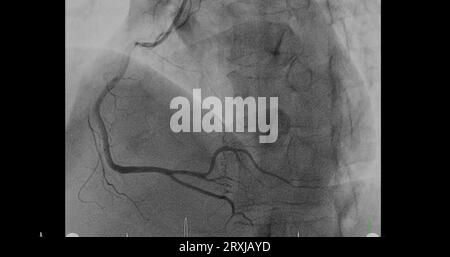 Herzkatheterisierung an der rechten Koronararterie (RCA) kann dem Arzt helfen, Probleme in Ihrem Herz und Ihren Blutgefäßen, wie z. B. ein Herz bei, zu diagnostizieren und zu behandeln Stockfoto