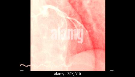 Herzkatheterisierung an der linken anterioren absteigenden Arterie (LAD) kann dem Arzt bei der Diagnose und Behandlung von Problemen in Ihrem Herz und Blutgefäßen wie helfen Stockfoto