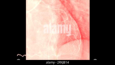 Herzkatheterisierung an der linken anterioren absteigenden Arterie (LAD) kann dem Arzt bei der Diagnose und Behandlung von Problemen in Ihrem Herz und Blutgefäßen wie helfen Stockfoto