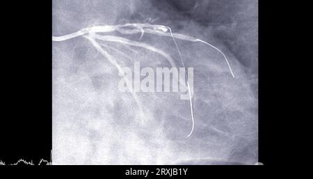 Herzkatheterisierung an der linken anterioren absteigenden Arterie (LAD) kann dem Arzt bei der Diagnose und Behandlung von Problemen in Ihrem Herz und Blutgefäßen wie helfen Stockfoto