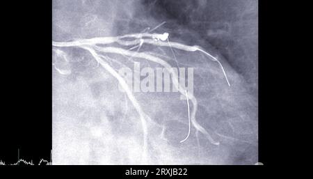 Herzkatheterisierung an der linken anterioren absteigenden Arterie (LAD) kann dem Arzt bei der Diagnose und Behandlung von Problemen in Ihrem Herz und Blutgefäßen wie helfen Stockfoto