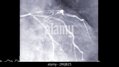 Herzkatheterisierung an der linken anterioren absteigenden Arterie (LAD) kann dem Arzt bei der Diagnose und Behandlung von Problemen in Ihrem Herz und Blutgefäßen wie helfen Stockfoto