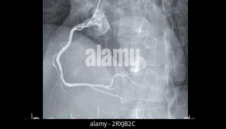 Herzkatheterisierung an der rechten Koronararterie (RCA) kann dem Arzt helfen, Probleme in Ihrem Herz und Ihren Blutgefäßen, wie z. B. ein Herz bei, zu diagnostizieren und zu behandeln Stockfoto