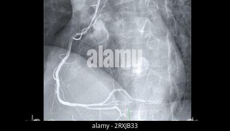 Herzkatheterisierung an der rechten Koronararterie (RCA) kann dem Arzt helfen, Probleme in Ihrem Herz und Ihren Blutgefäßen, wie z. B. ein Herz bei, zu diagnostizieren und zu behandeln Stockfoto