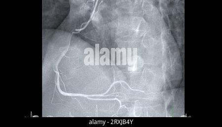 Herzkatheterisierung an der rechten Koronararterie (RCA) kann dem Arzt helfen, Probleme in Ihrem Herz und Ihren Blutgefäßen, wie z. B. ein Herz bei, zu diagnostizieren und zu behandeln Stockfoto