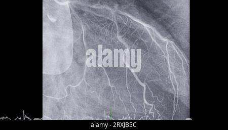 Herzkatheterisierung an der linken anterioren absteigenden Arterie (LAD) kann dem Arzt bei der Diagnose und Behandlung von Problemen in Ihrem Herz und Blutgefäßen wie helfen Stockfoto