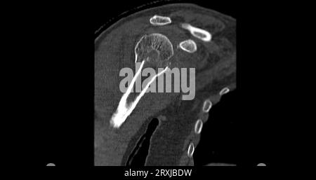 CT-Scan des Schultergelenks bei fallender Schultergelenkfraktur. Stockfoto