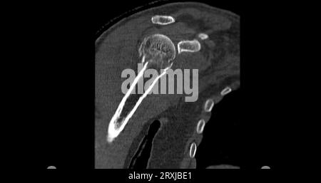 CT-Scan des Schultergelenks bei fallender Schultergelenkfraktur. Stockfoto