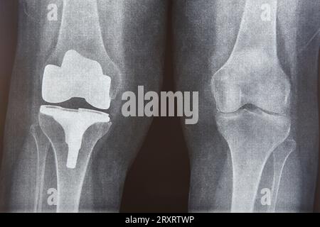 Kniekappenersatz-Röntgenaufnahmen. Titanimplantat. Osteoarthritis. Gelenkknorpel Stockfoto