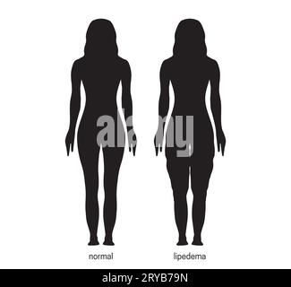 Illustration mit Frau Silhouette mit normalen und Lipedema Beinen Stock Vektor