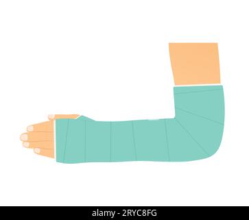 Gebrochener Arm mit Putz- Vektorillustration Stock Vektor