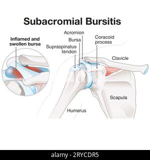 Eine Bursitis subacromialis ist eine Entzündung der Bursa in der Schulter, die Schmerzen, Schwellungen und eine eingeschränkte Mobilität verursacht und häufig mit Rotatorenmanschette in Verbindung gebracht wird Stockfoto