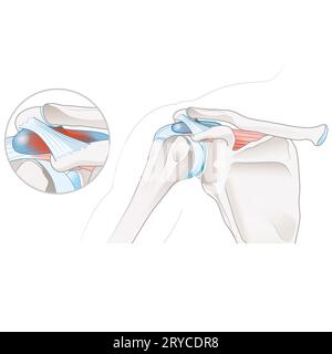 Eine Bursitis subacromialis ist eine Entzündung der Bursa in der Schulter, die Schmerzen, Schwellungen und eine eingeschränkte Mobilität verursacht und häufig mit Rotatorenmanschette in Verbindung gebracht wird Stockfoto