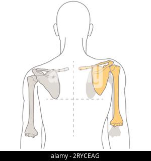 Die Dyskinese der Schulterhöhle ist eine abnorme Bewegung der Schulterblätter, die oft auf Muskelungleichgewichte zurückzuführen ist und zu Schmerzen, Funktionsstörungen und Veränderungen der Schulter führt Stockfoto