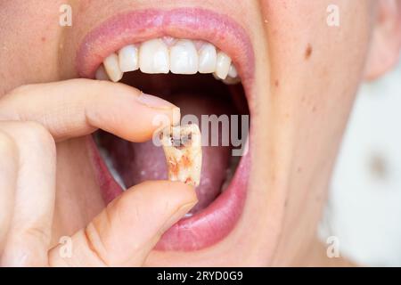 Ein Mädchen in der Hand hält einen ausgezogenen Zahn mit einem schwarzen Loch in der Mitte des Zahns nah an, einen kranken Zahn in der Hand nach der Entfernung, der n könnte Stockfoto