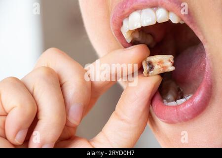 Ein Mädchen in der Hand hält einen ausgezogenen Zahn mit einem schwarzen Loch in der Mitte des Zahns nah an, einen kranken Zahn in der Hand nach der Entfernung, der n könnte Stockfoto