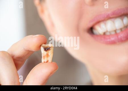Ein Mädchen in der Hand hält einen ausgezogenen Zahn mit einem schwarzen Loch in der Mitte des Zahns nah an, einen kranken Zahn in der Hand nach der Entfernung, der n könnte Stockfoto