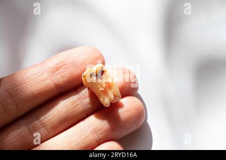 Ein Mädchen in der Hand hält einen ausgezogenen Zahn mit einem schwarzen Loch in der Mitte des Zahns, nah oben auf einem Tisch, in der Hand hält sie einen kranken Zahn afte Stockfoto